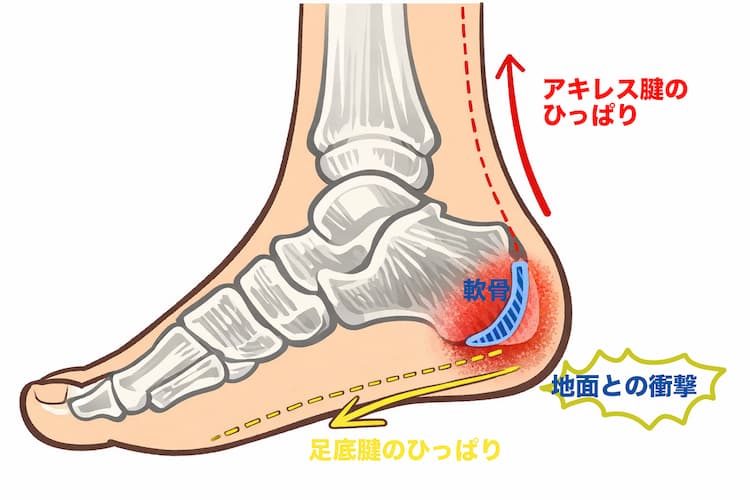 かかとの痛み